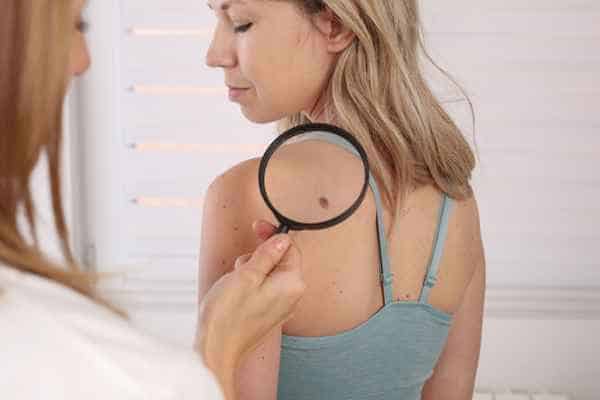 What Are Traditional Skin Lesion Removal Methods Sunbury?
