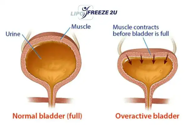 diagram of overactive bladder treatment Sunbury