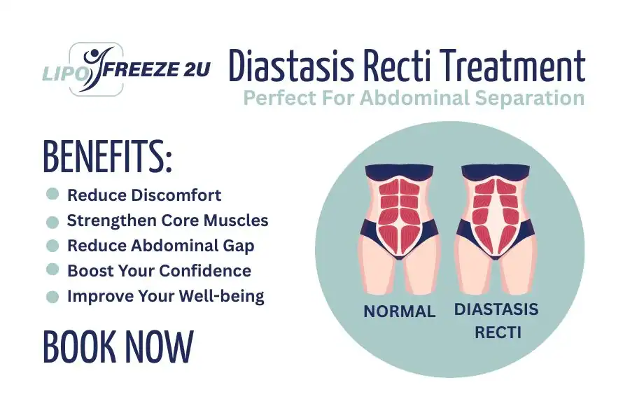 Benefits of body toning treatment Sunbury for Diastasis recti