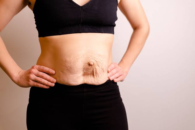 Is Surgery Really the Only Way to Repair Diastasis Recti Sunbury?