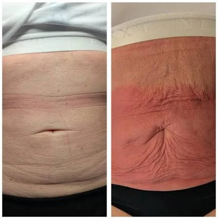 How Does RF Microneedling Improve Crepey, Thin and Uneven Skin Texture Sunbury?