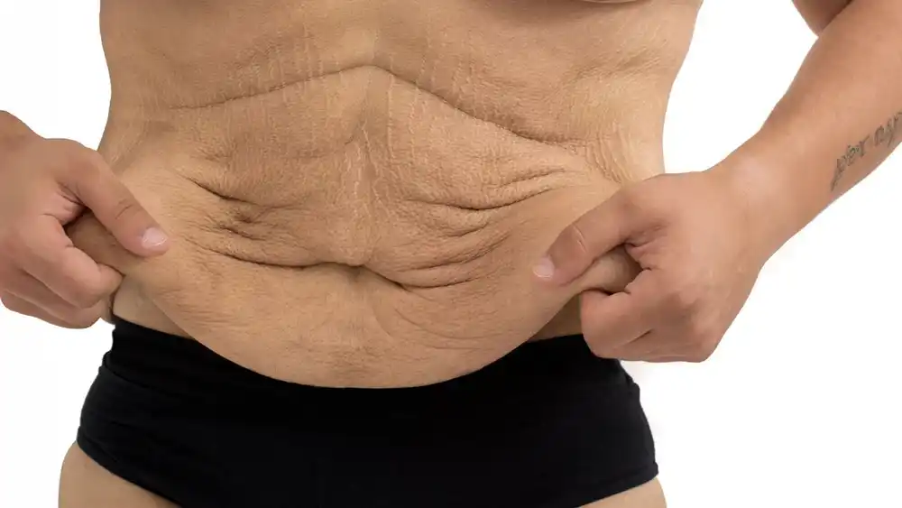 RF Microneedling for Loose Skin: How Can It Help Tighten and Reshape the Skin Sunbury?
